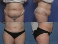 Abdominoplasty 1