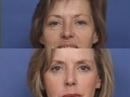 Blepharoplasty 1