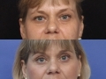 Blepharoplasty 2