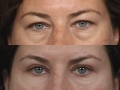 Blepharoplasty 3