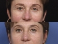 Blepharoplasty 4