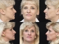 Blepharoplasty 7