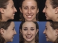 rhinoplasty-10