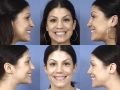 rhinoplasty-14