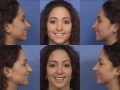 rhinoplasty-16