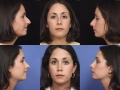 rhinoplasty-6